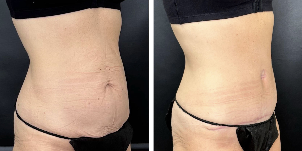 before and after tummy tuck right angled view female patient case 960