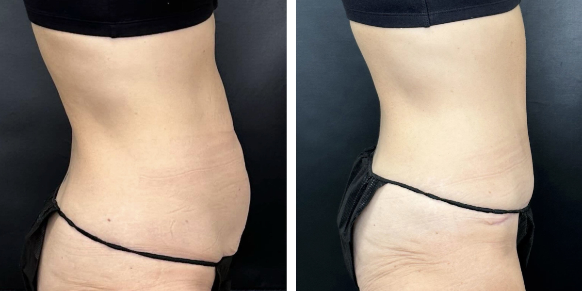 before and after tummy tuck right side view female patient case 960