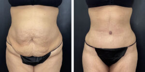 before and after tummy tuck front view female patient case 966