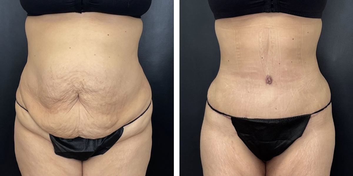 before and after tummy tuck front view female patient case 966