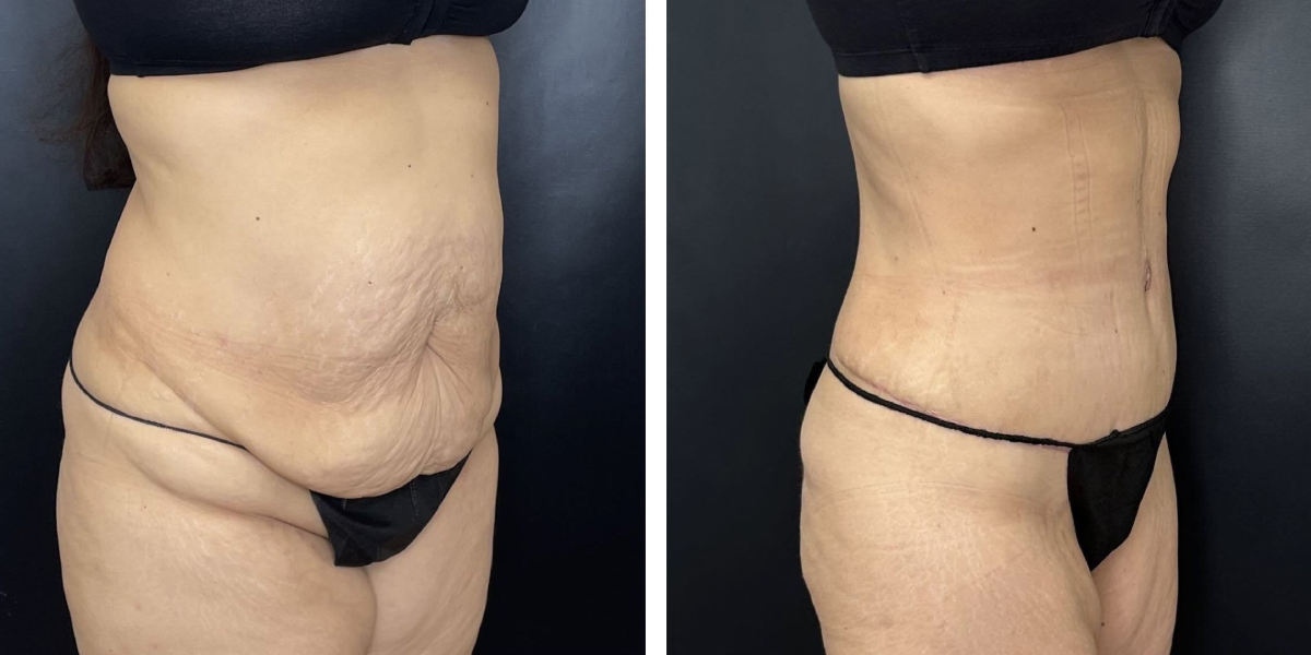 before and after tummy tuck right angled view female patient case 966
