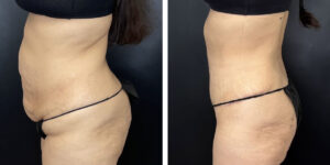 before and after tummy tuck left side view female patient case 966