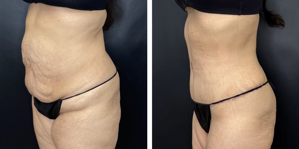 before and after tummy tuck left angled view female patient case 966