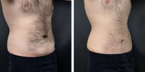 before and after tummy tuck right angled view male patient case 972