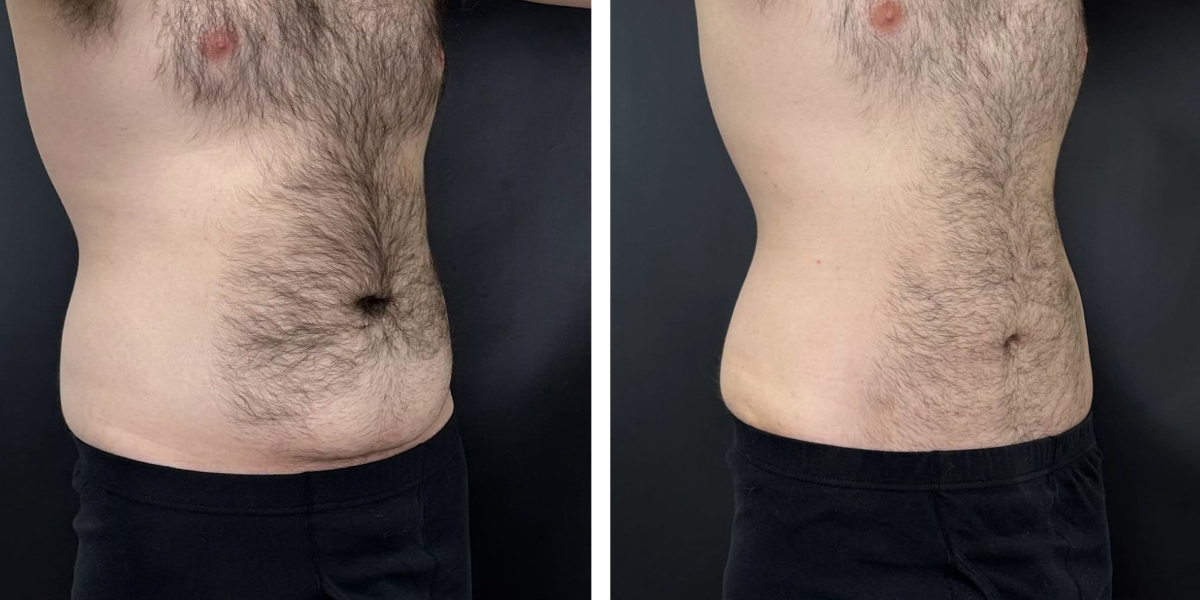 before and after tummy tuck right angled view male patient case 972