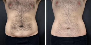 before and after tummy tuck front view male patient case 972