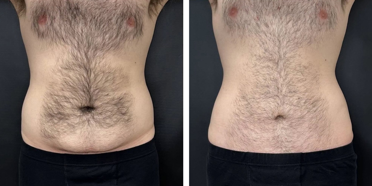 before and after tummy tuck front view male patient case 972