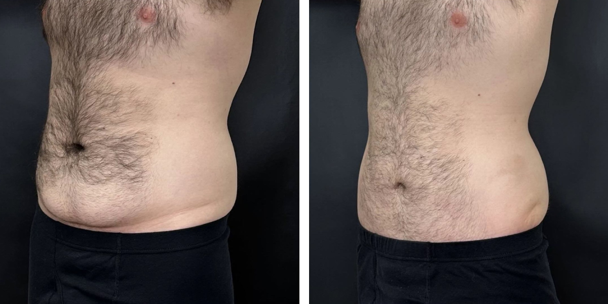 before and after tummy tuck left angled view male patient case 972