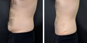 before and after tummy tuck left side view male patient case 972