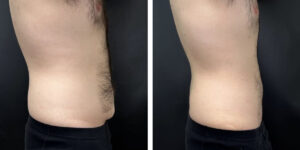 before and after tummy tuck right side male patient case 972