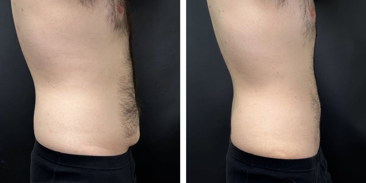 before and after tummy tuck right side male patient case 972