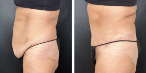 before and after tummy tuck left side view female patient case 978
