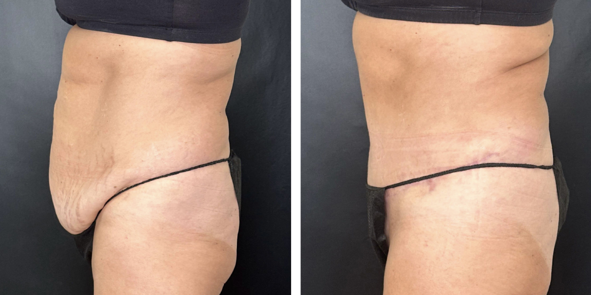 before and after tummy tuck left side view female patient case 978
