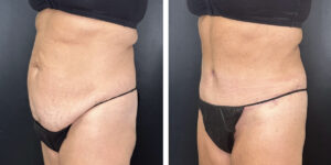 before and after tummy tuck left angled view female patient case 978