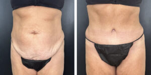 before and after tummy tuck front view female patient case 978