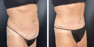 before and after tummy tuck right angled view female patient case 978