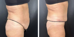 before and after tummy tuck right side view female patient case 978