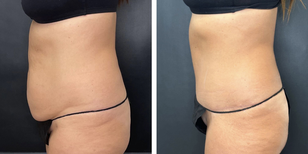 before and after tummy tuck left side view female patient case 984