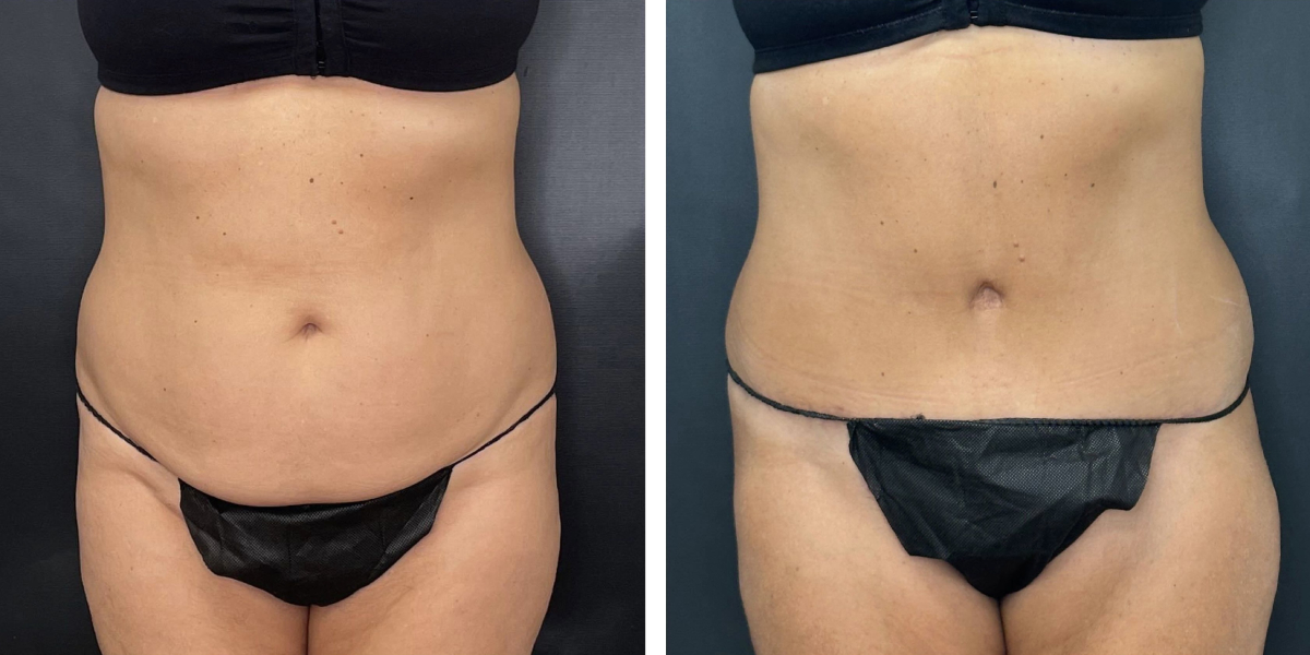 before and after tummy tuck front view female patient case 984