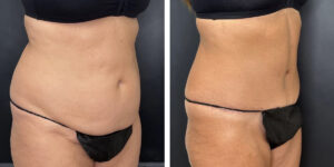 before and after tummy tuck right angled view female patient case 984
