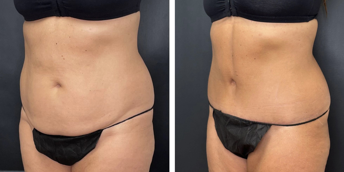before and after tummy tuck left angled view female patient case 984
