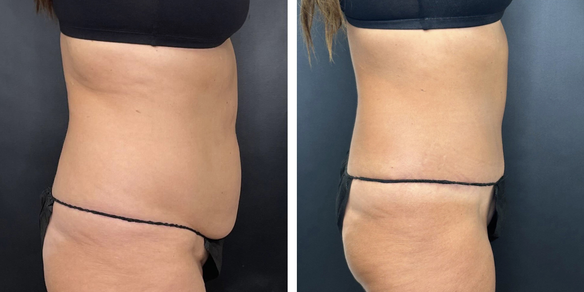 before and after tummy tuck right side view female patient case 984