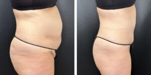 before and after tummy tuck right side view female patient case 990
