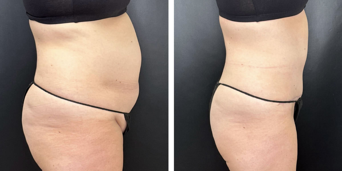 before and after tummy tuck right side view female patient case 990