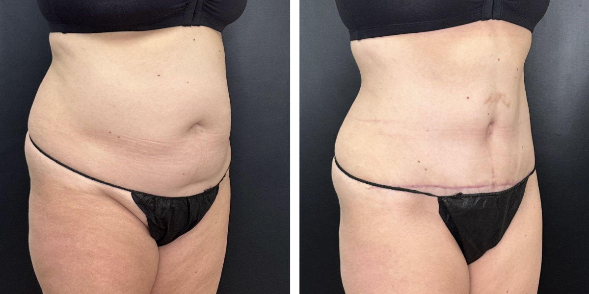 before and after tummy tuck right angled view female patient case 990