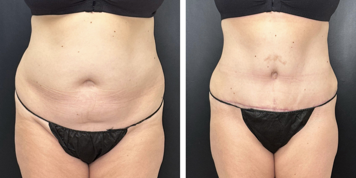 before and after tummy tuck front view female patient case 990