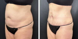 before and after tummy tuck left angled view female patient case 990