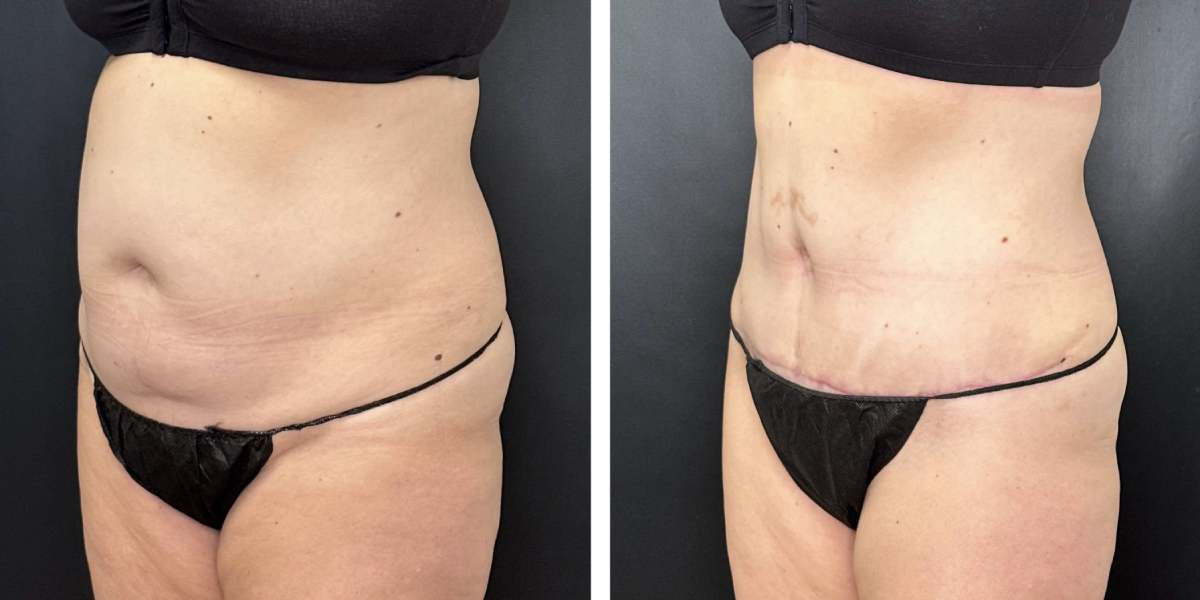 before and after tummy tuck left angled view female patient case 990