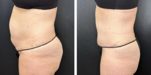 before and after tummy tuck left side view female patient case 990