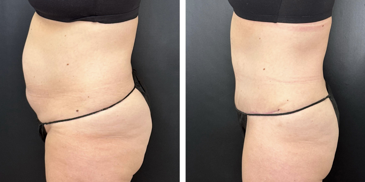 before and after tummy tuck left side view female patient case 990