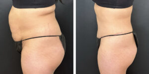 before and after tummy tuck left side view female patient case 996