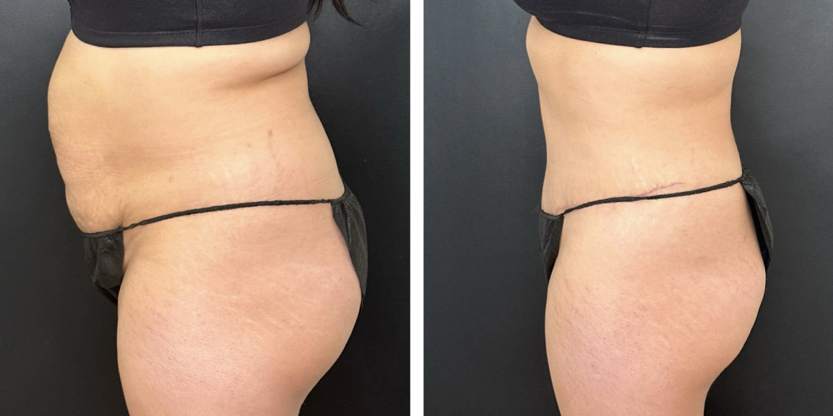 before and after tummy tuck left side view female patient case 996
