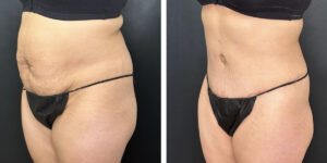 before and after tummy tuck left angled view female patient case 996