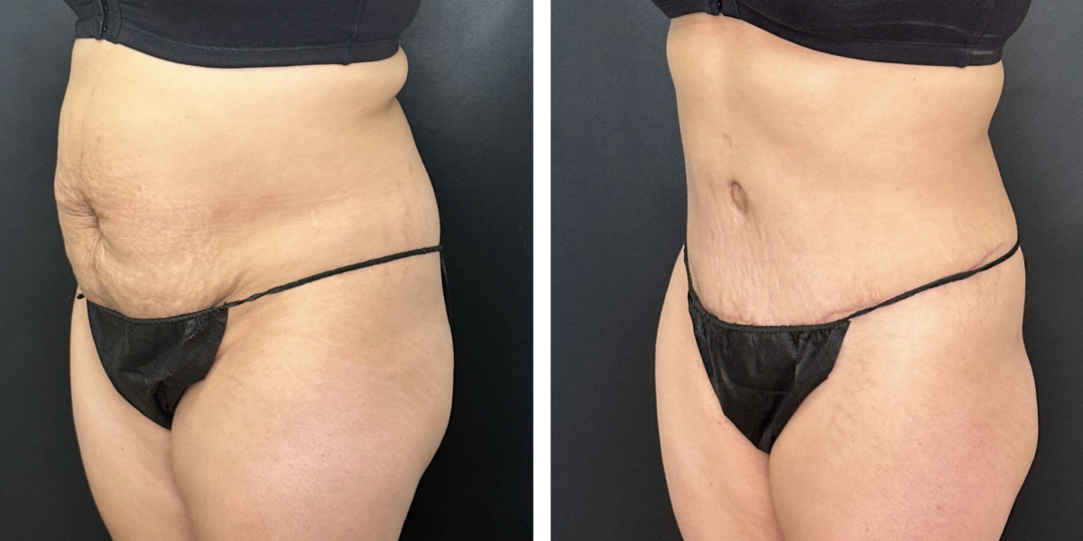 before and after tummy tuck left angled view female patient case 996