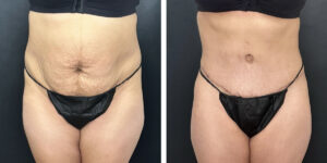 before and after tummy tuck front view female patient case 996
