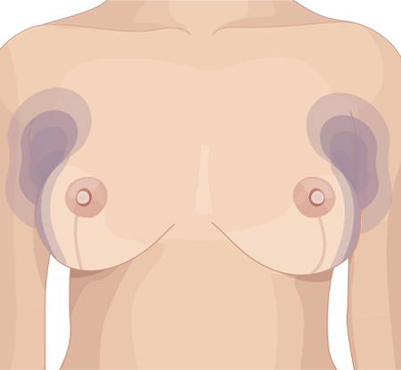 Liposuction Markings