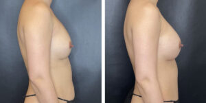 before and after breast implant exchange female patient right side view case 4728