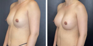 before and after breast implant exchange female patient left angled view case 4728