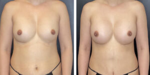 before and after breast implant exchange female patient front view case 4728