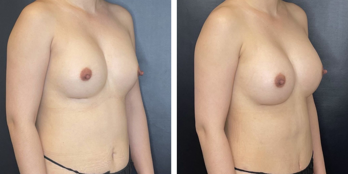 before and after breast implant exchange female patient right angled view case 4728