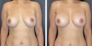 before and after breast implant exchange female patient front view case 4738