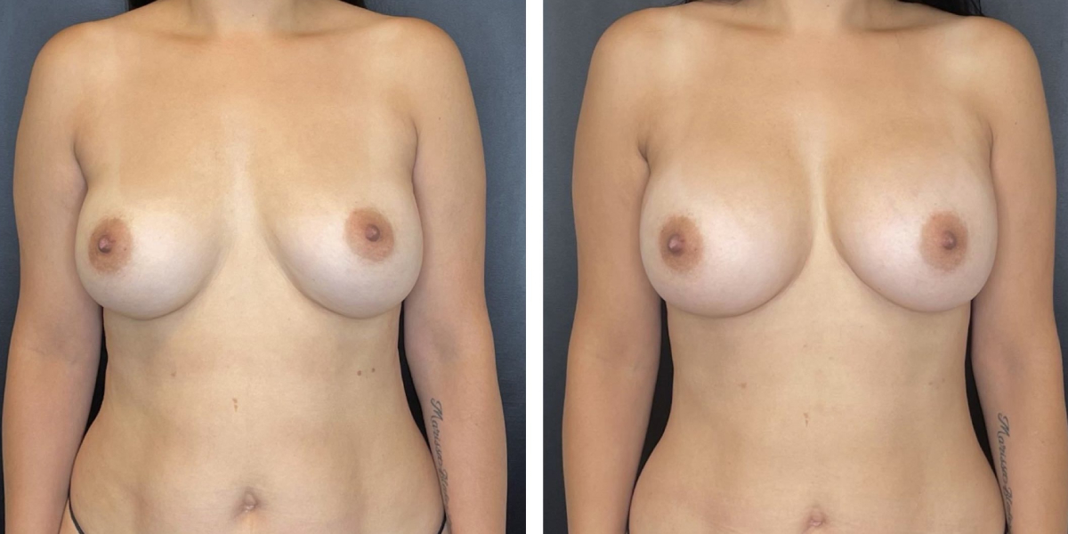 before and after breast implant exchange female patient front view case 4738