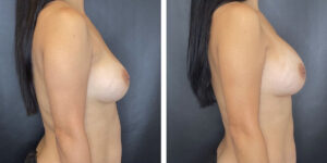 before and after breast implant exchange female patient right side view case 4738