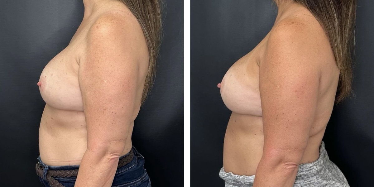 before and after breast implant exchange female patient left side view case 4744