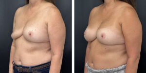 before and after breast implant exchange female patient left angle view case 4744