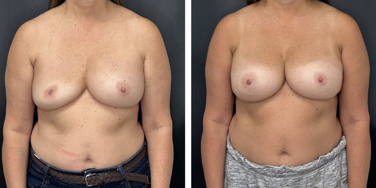 before and after breast implant exchange female patient front view case 4744